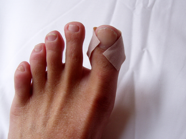 Numbness, or peripheral nerve pain  in the toes is often the first sign of diabetes.