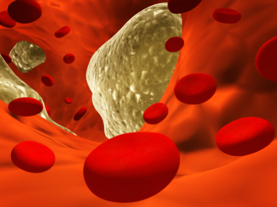 Low cholesterol diet tips as part of  a heart healthy diet - Athresclerosis - Blood lipids - lipoprotein-a